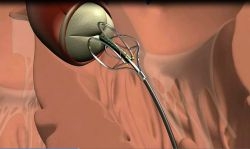 חברת MediValve הישראלית קיבלה אישורי FDA ו-CE